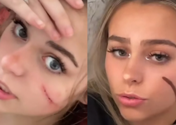 The Tiktok Controversy Of Scar Girl