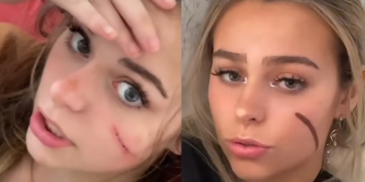 The Tiktok Controversy Of Scar Girl