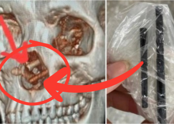 Drunk Man Forgets He Got Stabbed in the Face with Chopsticks