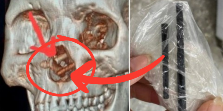 Drunk Man Forgets He Got Stabbed in the Face with Chopsticks