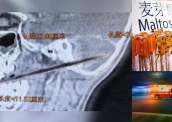 6-Year-Old Boy in China Falls While Eating Lollipop, Candy Stick Pierced Through His Brain