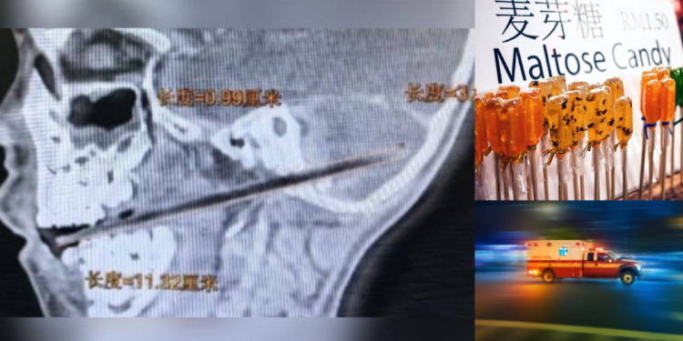 6-Year-Old Boy in China Falls While Eating Lollipop, Candy Stick Pierced Through His Brain