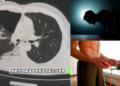 Man Suffers a Collapsed Lung After 20 Push-Ups and Jump Rope