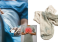 Man Hospitalized for Fungal Lung Infection After Smelling His Dirty Socks Daily