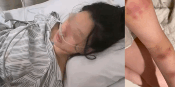 Woman Attacked in Parking Lot, Breast Implants Saved Her from Fatal Injuries