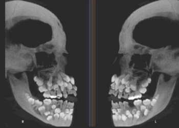 Brazilian Girl, 13, Discovered With 81 Teeth in Her Mouth