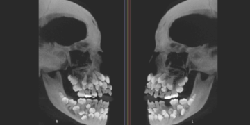 Brazilian Girl, 13, Discovered With 81 Teeth in Her Mouth