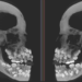 Brazilian Girl, 13, Discovered With 81 Teeth in Her Mouth