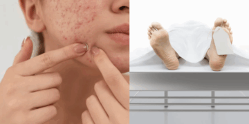 Teenage Girl in Vietnam Dies from Severe Infection After Popping Pimples
