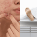 Teenage Girl in Vietnam Dies from Severe Infection After Popping Pimples