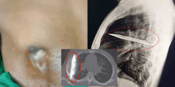 Doctors Remove Knife Stuck in Man’s Chest for Eight Years