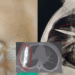 Doctors Remove Knife Stuck in Man’s Chest for Eight Years