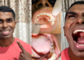 33-Year-Old Man Sets World Record With 42 Teeth—10 More Than Normal