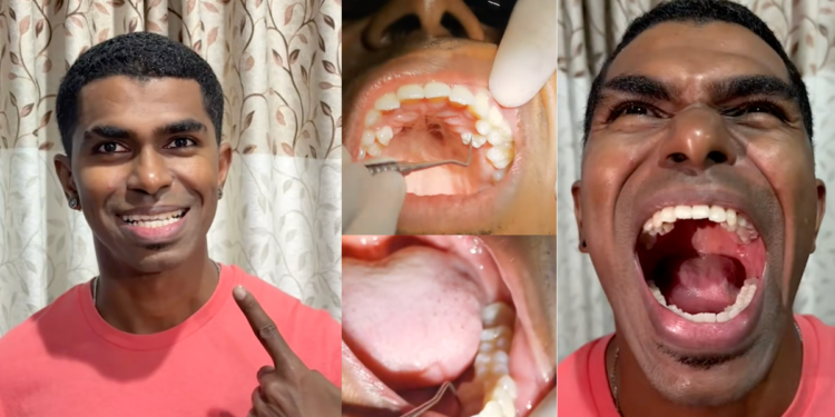 33-Year-Old Man Sets World Record With 42 Teeth—10 More Than Normal