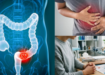 Malaysian Study Says Colon Cancer No Longer Affects Only Older Adults, But Younger People Too
