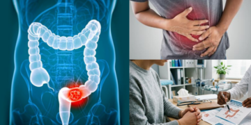 Malaysian Study Says Colon Cancer No Longer Affects Only Older Adults, But Younger People Too
